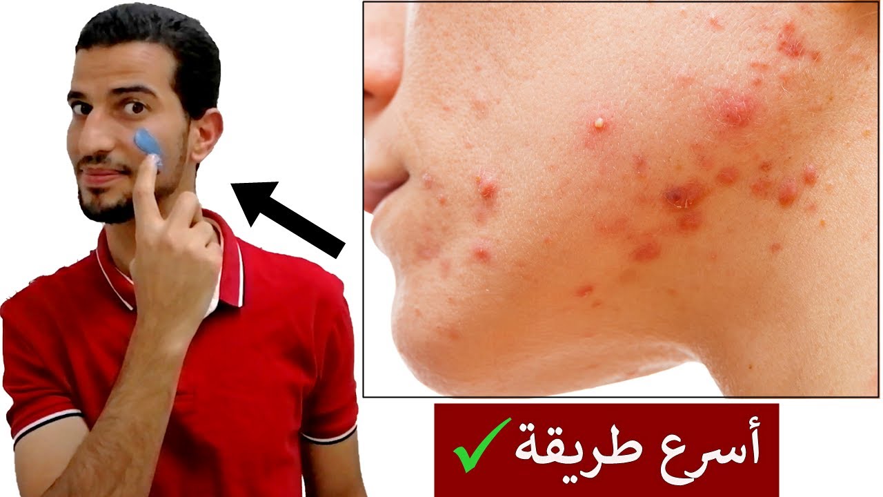 وصفة لإزالة الحبوب من الوجه نهائيا للحصول على بشرة صافية