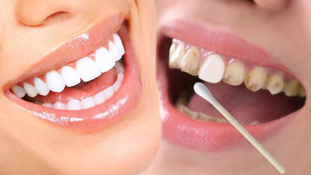 تبييض الأسنان في المنزل